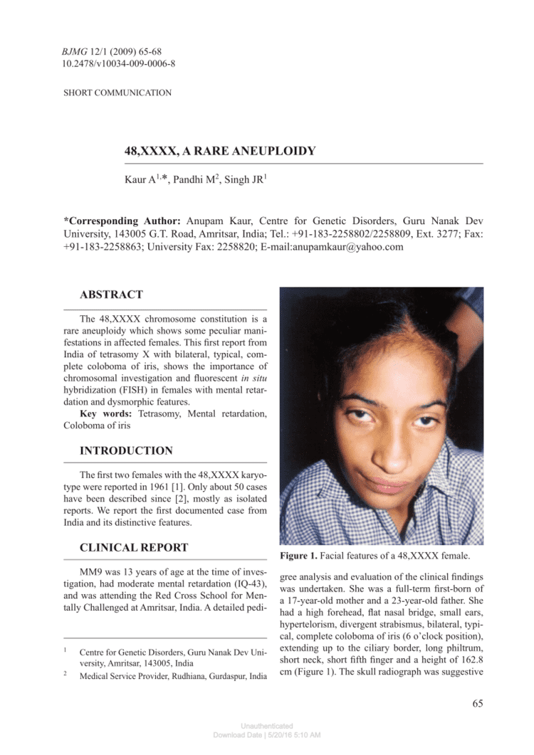 An article about 48 XXXX or Tetrasomy Syndrome with the facial features of an individual with the disease.