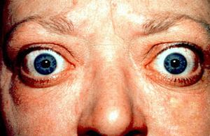 Abadie's sign of exophthalmic goiter
