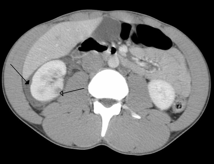 Abdominal trauma