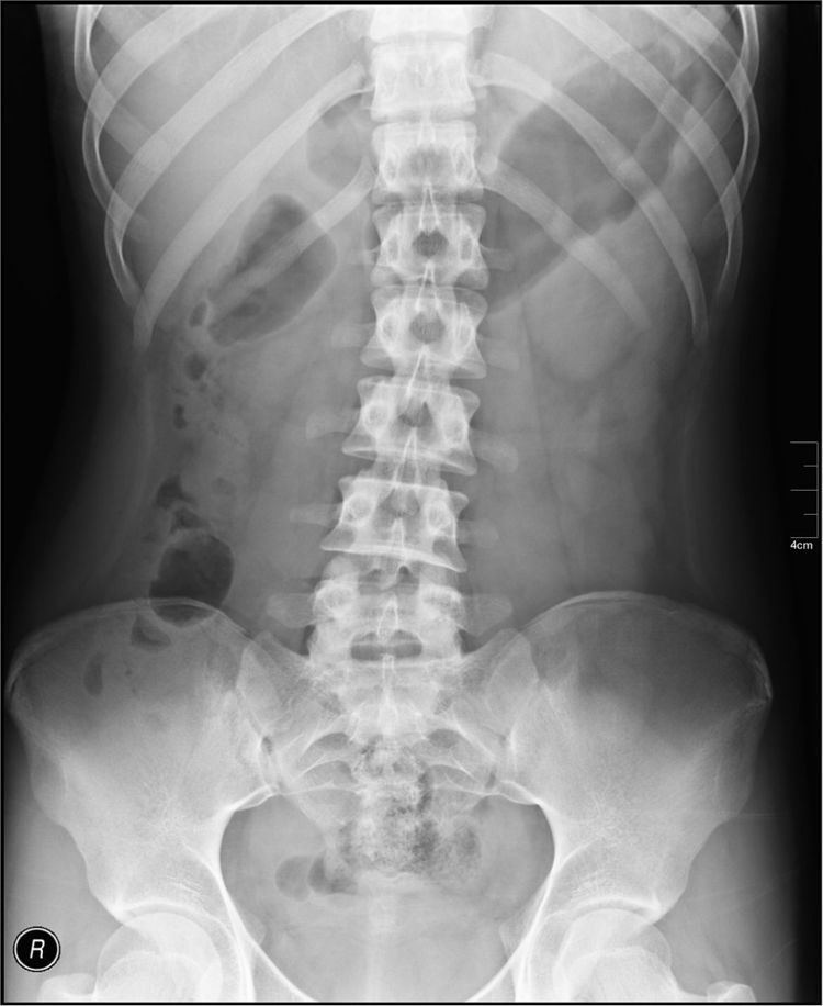 Abdominal x-ray