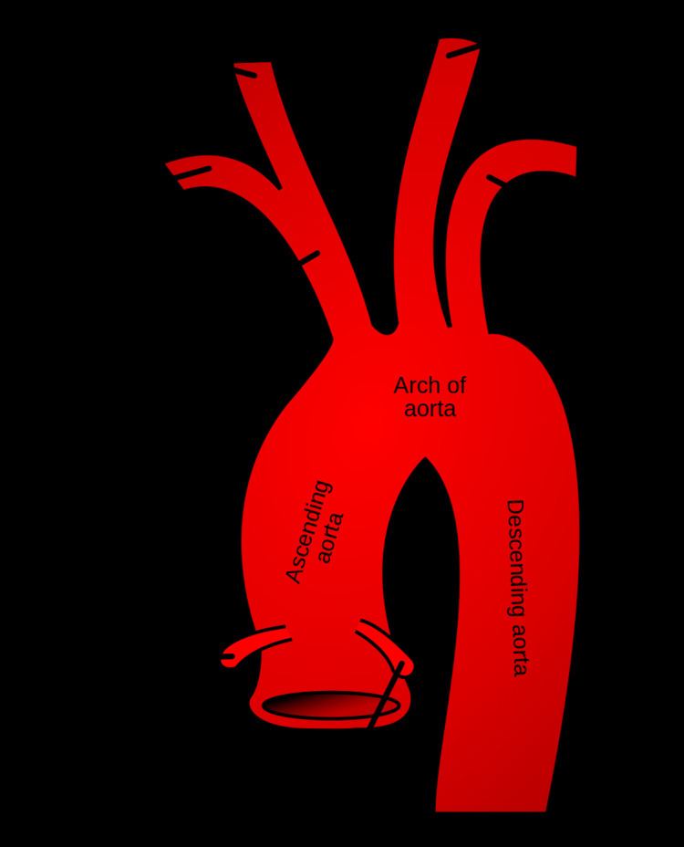 Aberrant subclavian artery