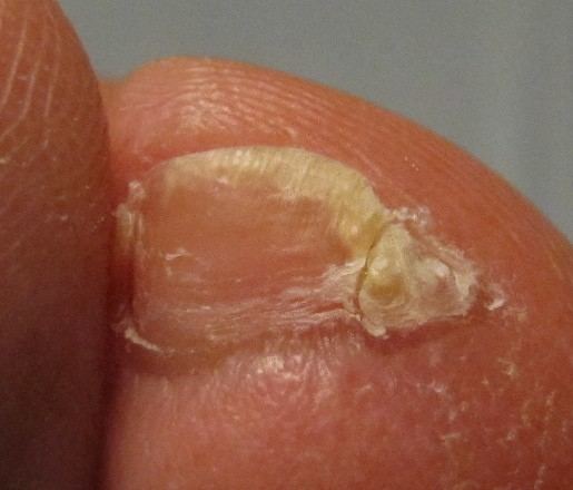 Accessory nail of the fifth toe