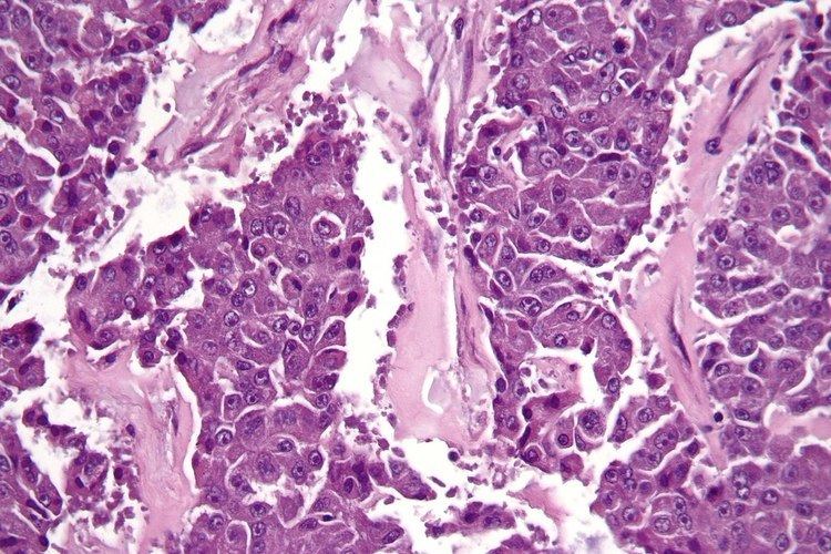 Acinar cell carcinoma of the pancreas