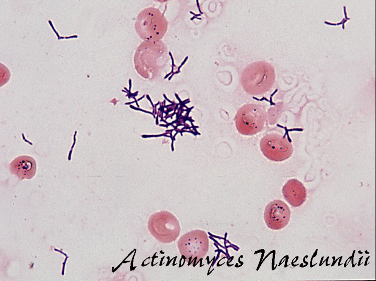 Actinomyces naeslundii Actinomyces Naeslundii Related Keywords amp Suggestions Actinomyces