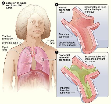 Acute bronchitis