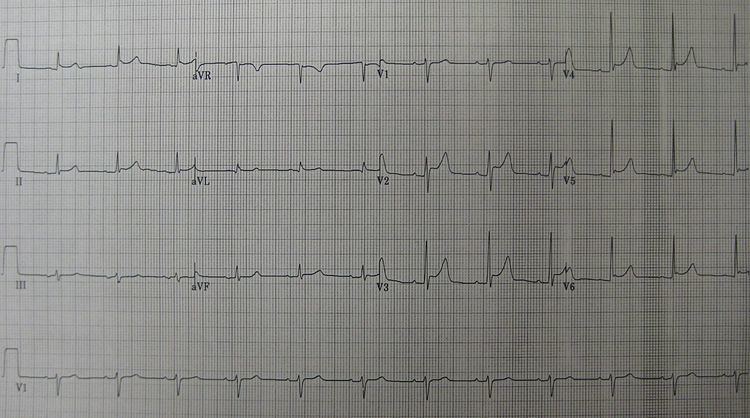 Acute pericarditis