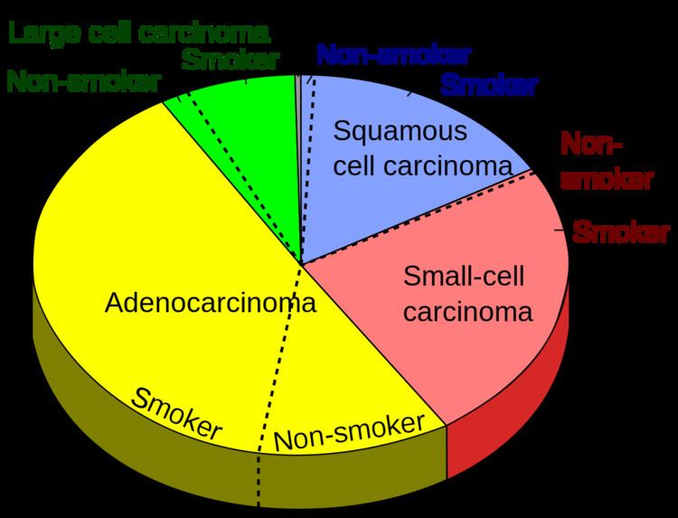 Adenocarcinoma of the lung