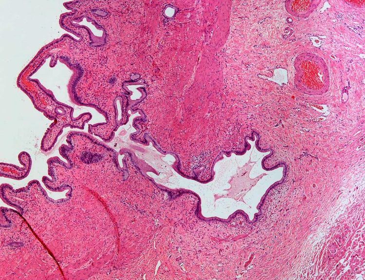 Adenomyomatosis