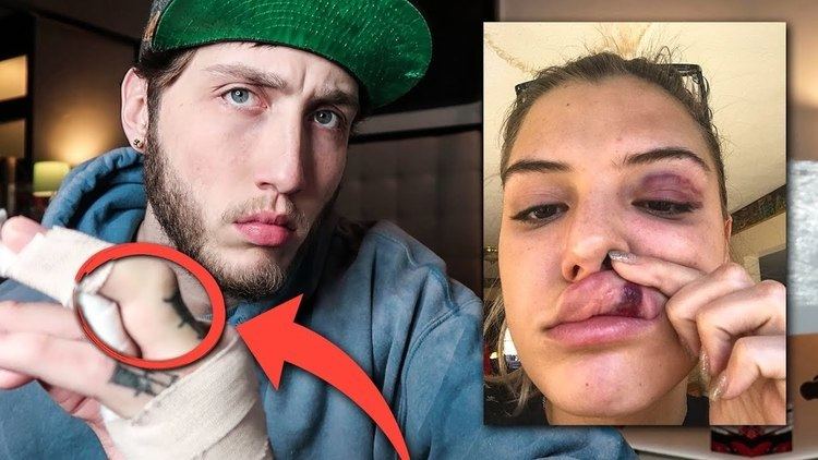 On the left, FaZe Banks with an angry face,  with bandages on his hands, wearing a green cap, and a gray jacket. On the right, Alissa Violet shows her lips with bruises, with a black eye, and with sunglasses on her head.