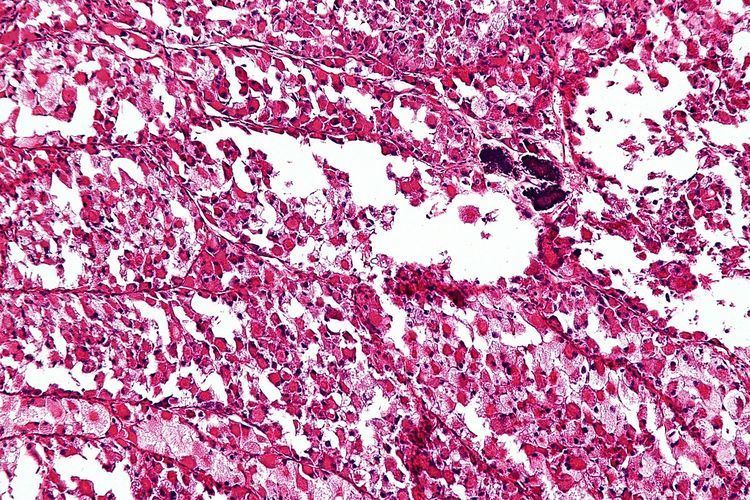 Alveolar soft part sarcoma