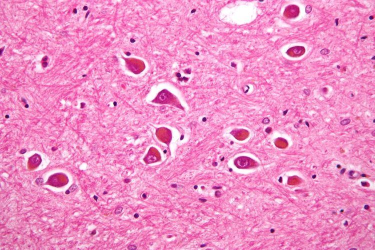 Alzheimer type II astrocyte