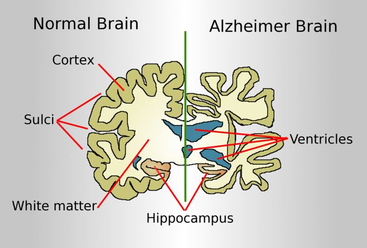Alzheimer's Disease Neuroimaging Initiative