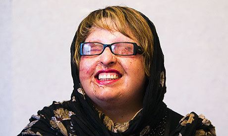 Ameneh Bahrami Iranian woman blinded by acid attack pardons assailant as