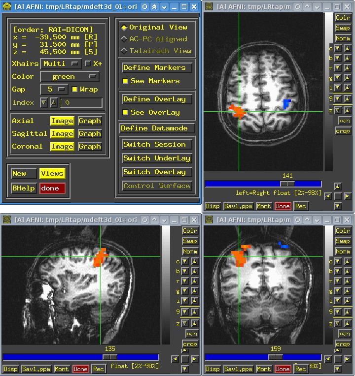 Analysis of Functional NeuroImages - Alchetron, the free social ...