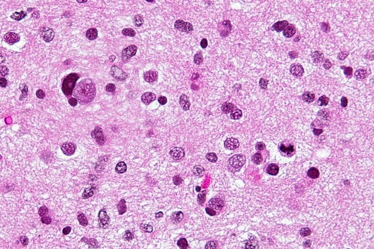 Anaplastic astrocytoma