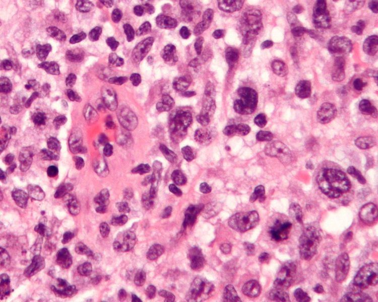 Anaplastic large-cell lymphoma