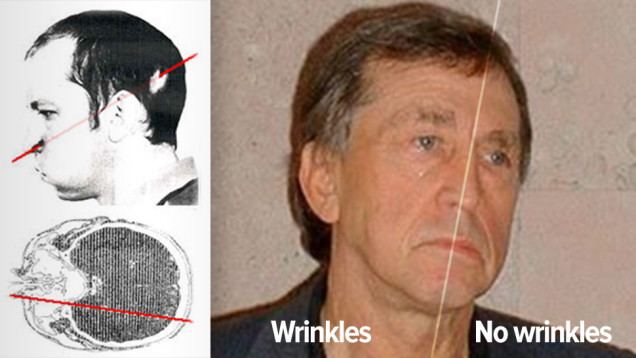 On the left, a diagram shows the path the beam took through Anatoli’s head. On the right, Anatoli Bugorski with a serious face showing the division of the part of it with wrinkles and no wrinkles. Anatoli is wearing a black coat.
