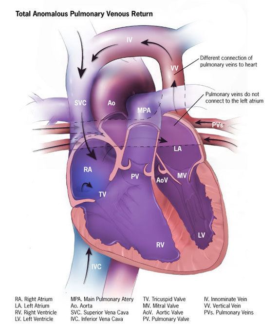 Anomalous pulmonary venous connection
