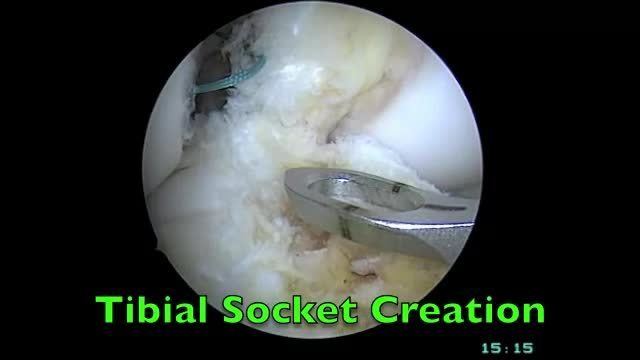 Anterior cruciate ligament reconstruction with contralateral autogenous patellar tendon graft