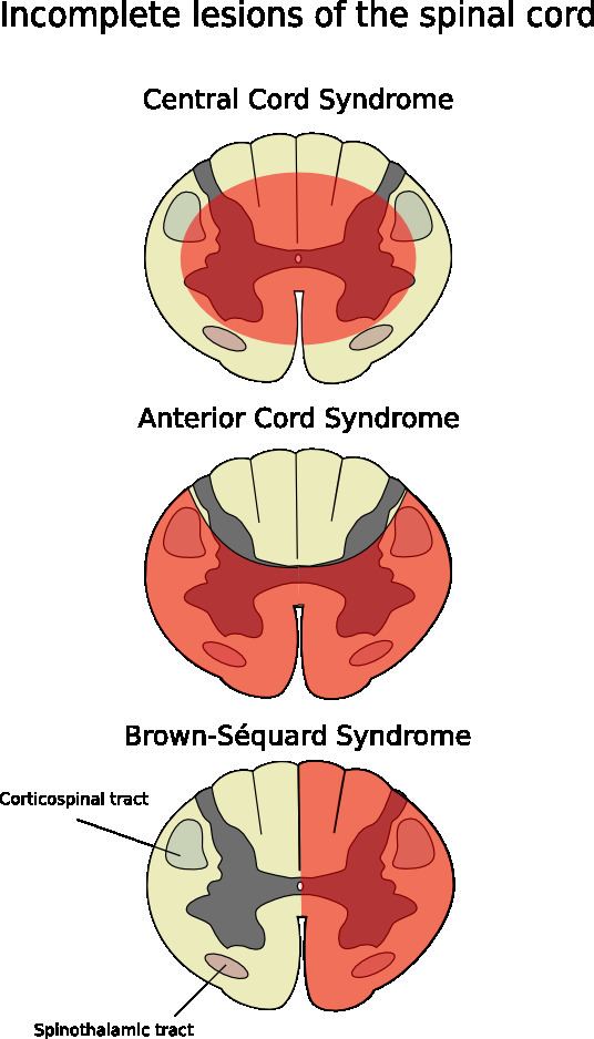 Anterior spinal artery syndrome