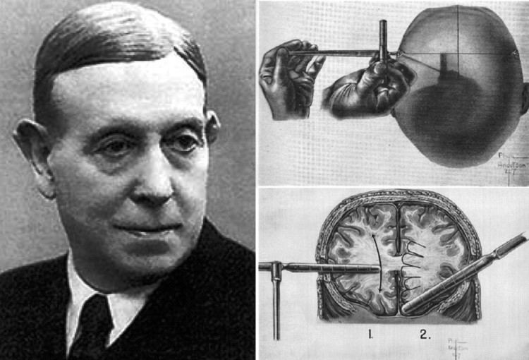 Antonio Egas Moniz Egas Moniz 18751955 the father of psychosurgery