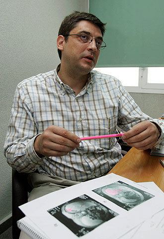Antonio Brú Un grupo espaol prueba con xito una nueva terapia en un paciente