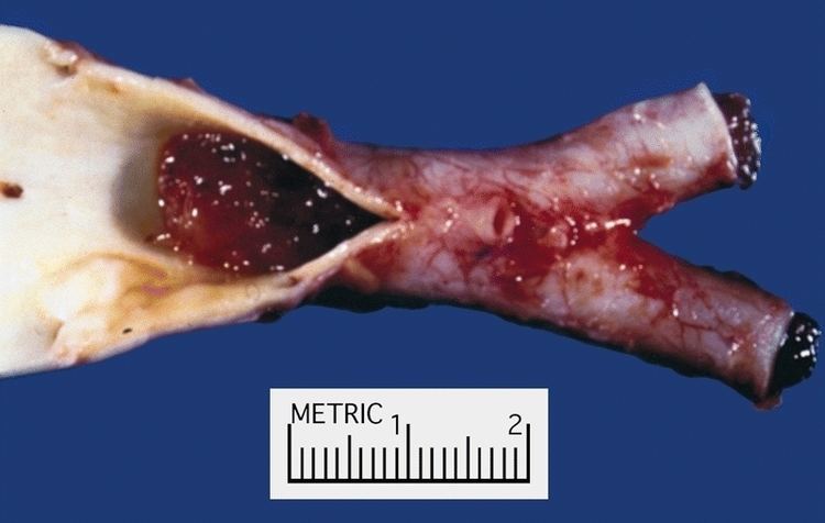 Arterial embolism