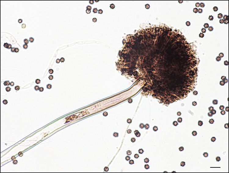 Otomycosis as seen in a microscope.