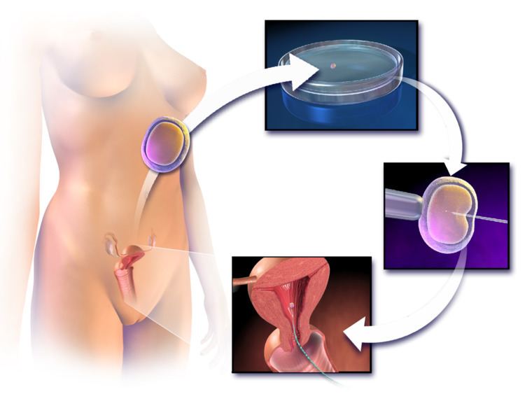 Assisted reproductive technology