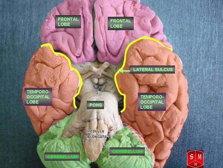 Associative visual agnosia