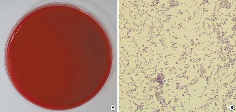 Atopobium A Case of Bacteremia by Atopobium rimae in a Patient with Liver