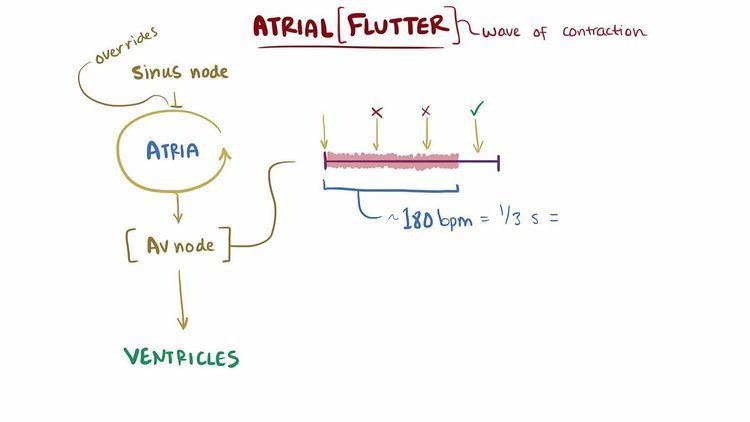 Atrial flutter