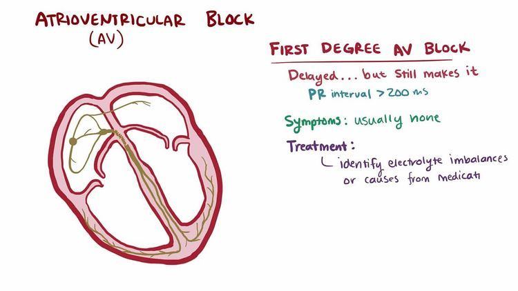 Atrioventricular block