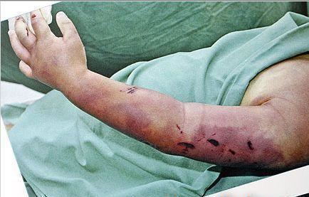 A photo showing the arm of Ngatikaura Ngati with bruises.
