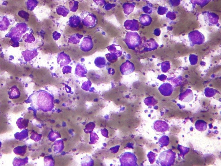 B-cell lymphoma