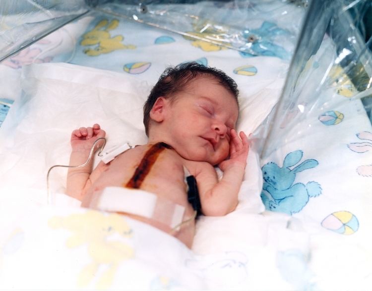 Baby Fae Infant Heart Anniversary Resources Loma Linda University