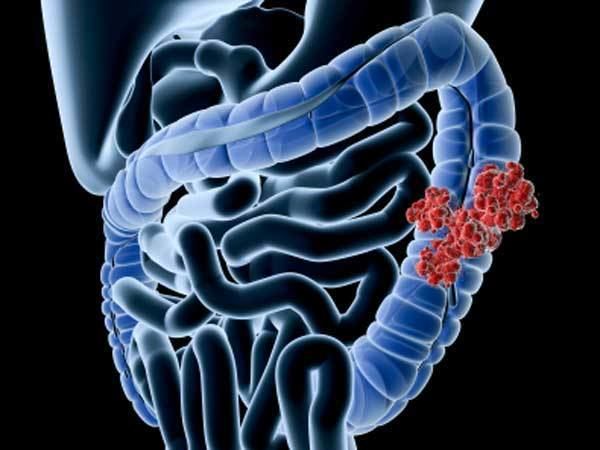 Bacillus fusiformis httpssrxafileswordpresscom201308coloncan