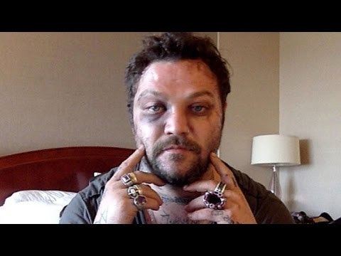 Bam Margera Bam Margera Shares Brutal Injury Photos After Attack by