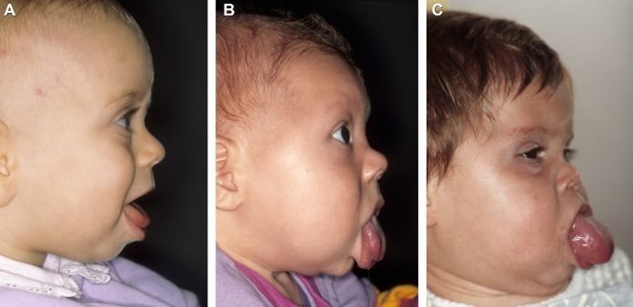 Tongue reduction in Beckwith–Wiedemann syndrome: outcome and treatment  algorithm - International Journal of Oral and Maxillofacial Surgery