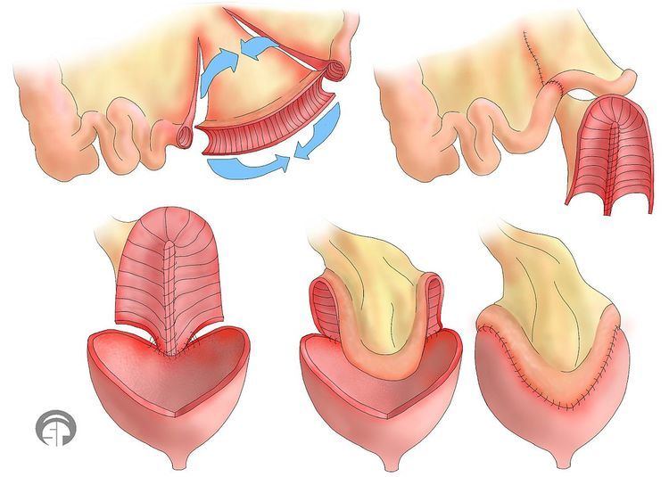 Bladder augmentation