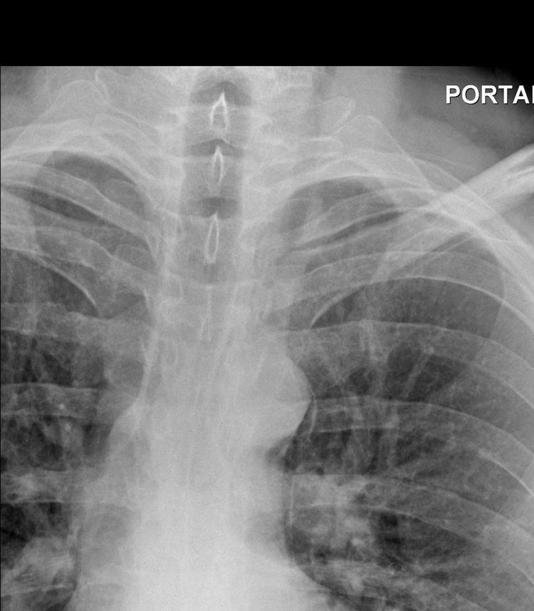 Boerhaave syndrome