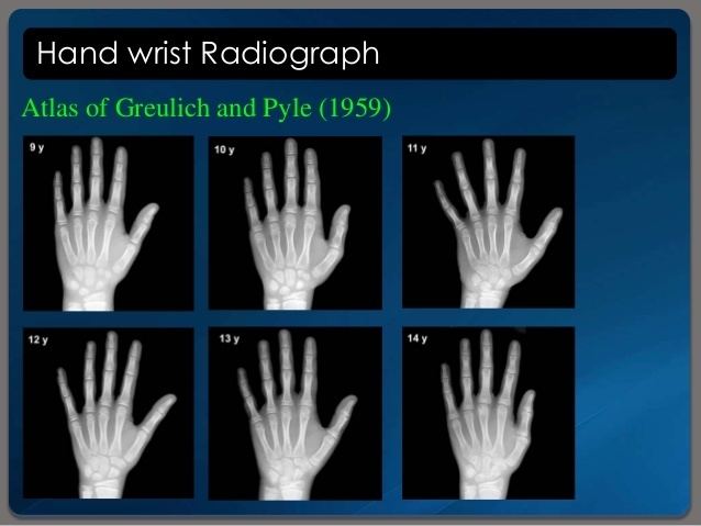 In the hand wrist Radiograph by Atlas of Greulich and Pyle (1959) is an image of hand and wrist, On the 1st row aged 9y, 10y, 11y, on the 2nd row 12y, 13y , and 14y.