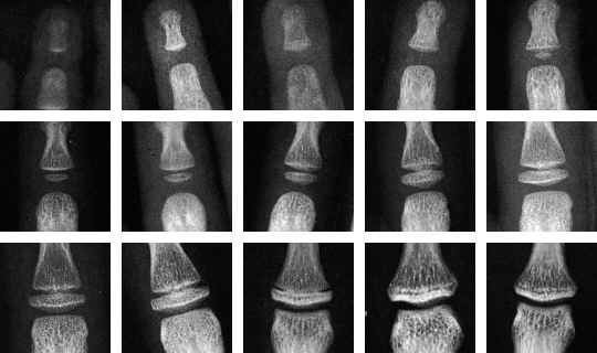 A Computerized image of bone age estimation, The 1st row from the 1st column  is the time lapse of two bones separated growing bigger up to the 4th column, in the first row 5th column two bones with a small bone started to grow in the middle. The 2nd row from the 1st column has a time lapse of three bones separated, getting closed and the middle bone growing bigger up to the 5th column. And the 3rd row from the 1st column is a time lapse of three bones growing and getting close together up to 4th Column, at the 3rd row 5th column the middle and the top bone finally merged.