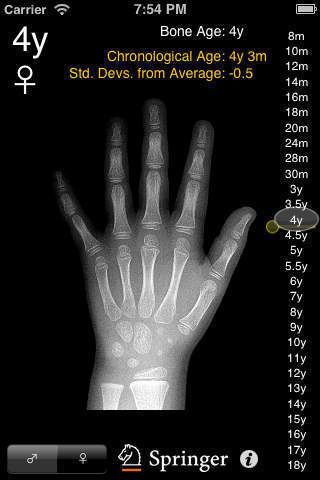 A Radiograph image of left hand in an app has age of 4y and a symbol of female, an age indicator on the right form 8m,10m,12m, 14m, 16m 28m, 20m, 24m, 30m, 3y, 4y, 4.5y, 5y, 5.5y, 6y,7y,8y,9y,10y,11y,12y,13y,14y,15y,16y,17y,18y with horse head and springer