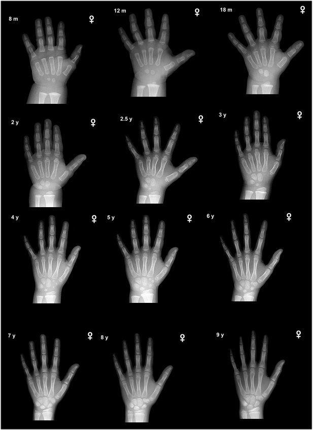 An X-ray image of Hands aging, has left hands x-ray image and indicating its age at the top left and gender symbol at the right side, starting from left, a left hand x-ray image of a female aging 8m, 12m, 18m, 2y, 2.5y, 3y, 4y, 5y, 6y, 7y, 8y, 9y.