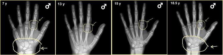 A Computerized image of bone in hands, with indicated age at the top left and male gender at the right, from left an image of 7 y.o male left hand is encircled carpal of the bone and index finger, next from left (2nd) is a hand of a 13y.o male, has a circle in the index finger, and the 3rd image from left is a hand if a 15 y.o, left hand with an encircled index finger, on right is 18.5 y.o male, the left hand is encircled and arrow pointed to the carpal bones and index finger.