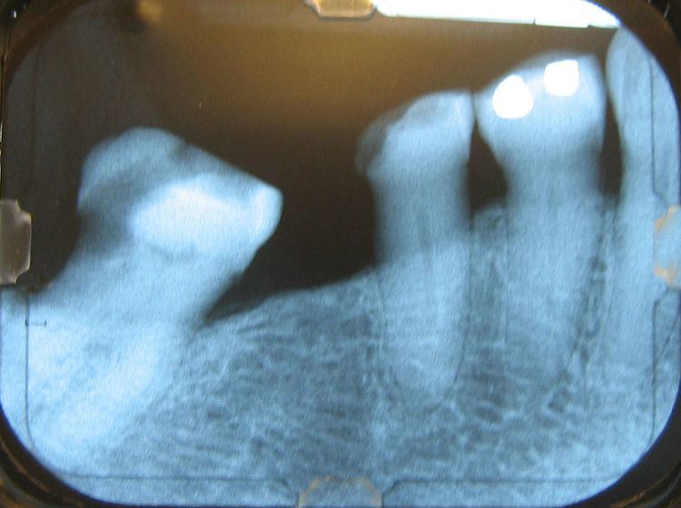 Bone destruction patterns in periodontal disease