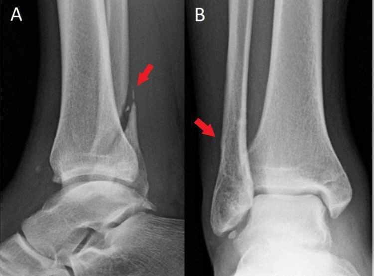 Cureus | A Novel Technique for a Successful Closed Reduction of a Bosworth  Fracture-Dislocation of the Ankle