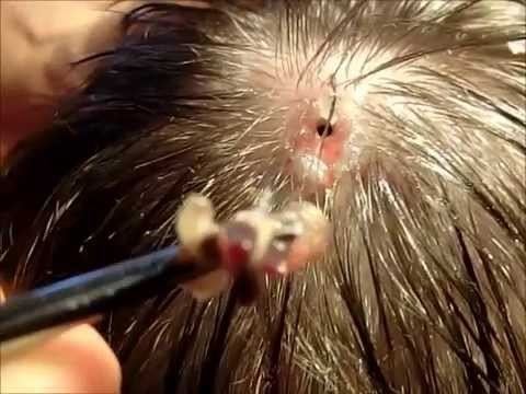 Botfly Huge Botfly Maggot Removed from Head YouTube