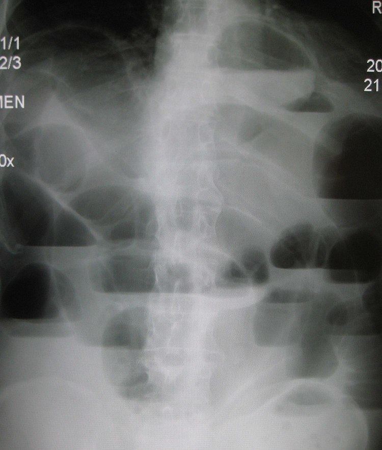 Bowel obstruction